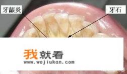 绝大部分人牙齿上都会有硬硬的脏东西，如何用土法去除？