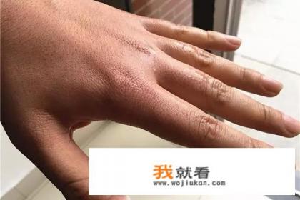 肝脏不好，手和脚有什么表现？