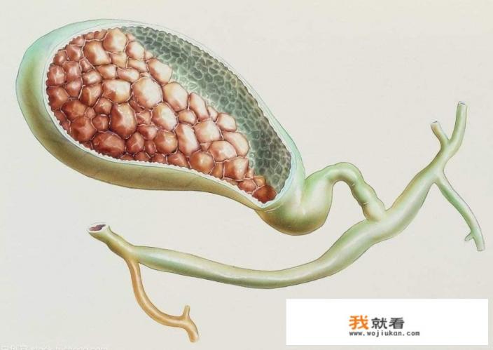 胆结石可以吃梨，苹果，这些水果？