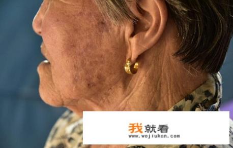 如何去除黄褐斑？