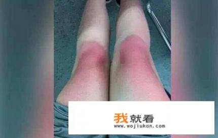 如何去除黄褐斑？