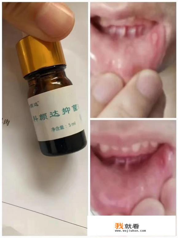 经常上火脸上长痘痘嘴巴口腔溃疡吃什么药可以下火？