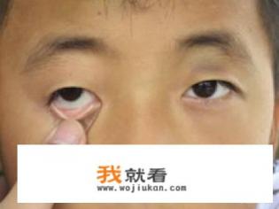贫血是哪些症状？