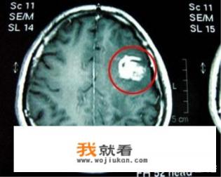 裂头蚴是怎样进入人脑的呢？如何预防呢？