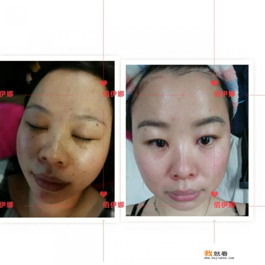 色斑去除最快的方法？