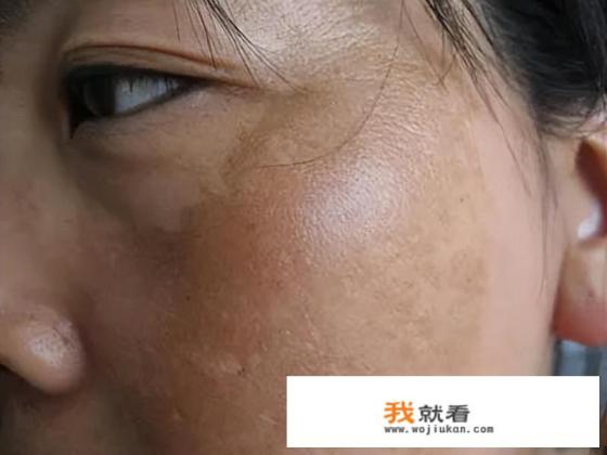 内调黄褐斑的办法是什么？