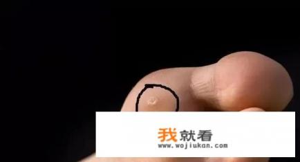 脚钉能自行消除吗？