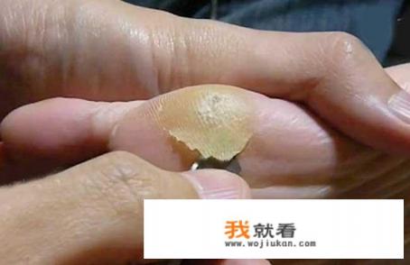 脚钉能自行消除吗？