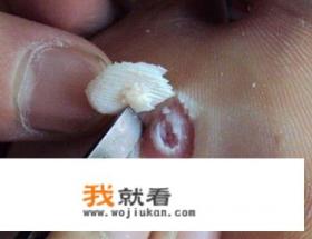 脚钉能自行消除吗？